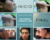 Tratamiento contra el Acné - 
Clínica dental CIEE - Clínica dental CIEE
